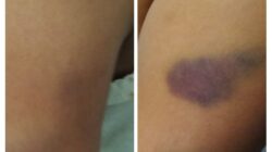 ‎Dugaan Perundungan di SDN 47 Rejang Lebong: 3 Siswa Kelas Bawah Diduga Dianiaya 13 Kakak Kelas  ‎