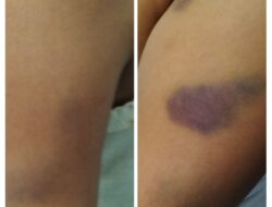 ‎Dugaan Perundungan di SDN 47 Rejang Lebong: 3 Siswa Kelas Bawah Diduga Dianiaya 13 Kakak Kelas  ‎